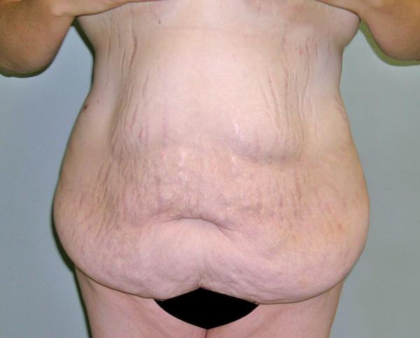 Tummy Tuck before at Dr. Zarrabi Plastic Surgery in Los Angeles, CA