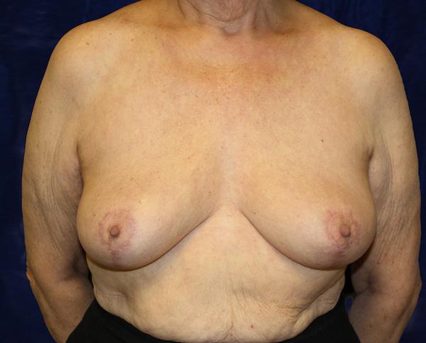 Breast Reduction after at Dr. Zarrabi Plastic Surgery in Los Angeles, CA