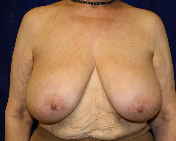 Breast Reduction before at Dr. Zarrabi Plastic Surgery in Los Angeles, CA