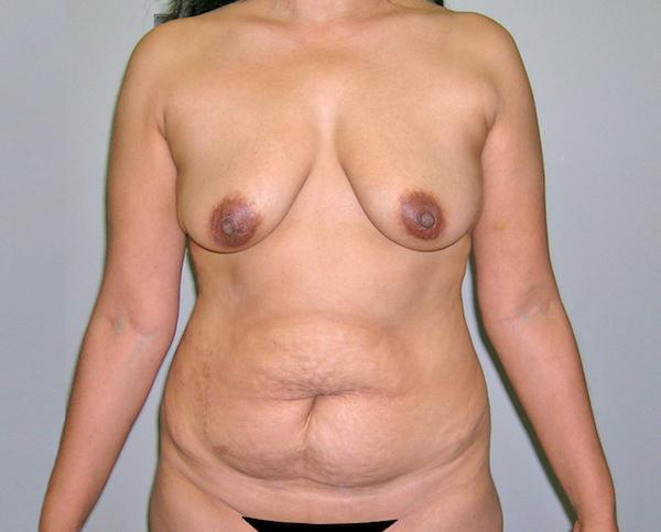 Mommy Makeover before at Dr. Zarrabi Plastic Surgery in Los Angeles, CA