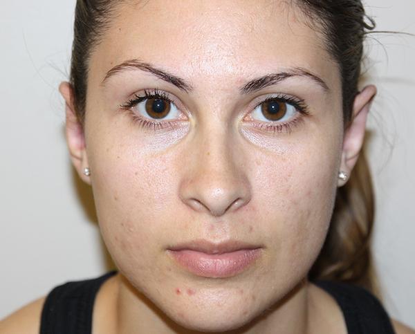 Dr. Zarrabi Plastic Surgery after — Los Angeles, CA