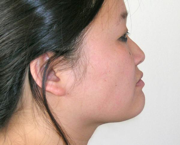 Neck Liposuction after at Dr. Zarrabi Plastic Surgery in Beverly Hills, CA