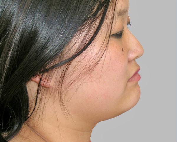 Neck Liposuction before at Dr. Zarrabi Plastic Surgery in Beverly Hills, CA
