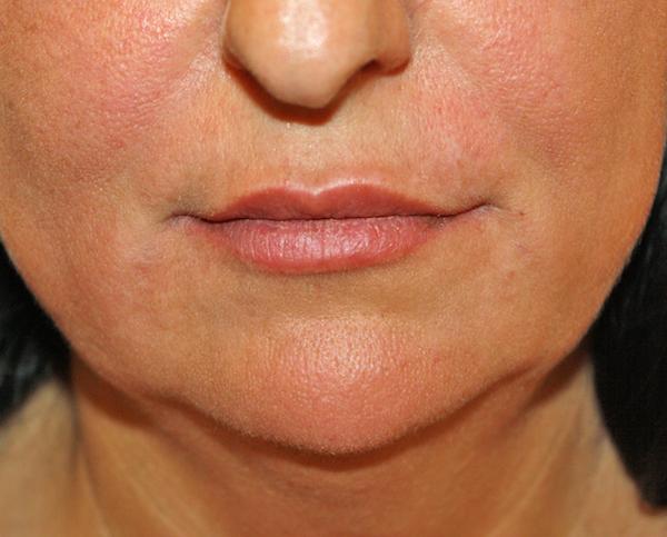 Dr. Zarrabi Plastic Surgery after — Los Angeles, CA