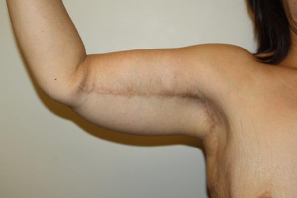 Arm Lift after at Dr. Zarrabi Plastic Surgery in Los Angeles, CA