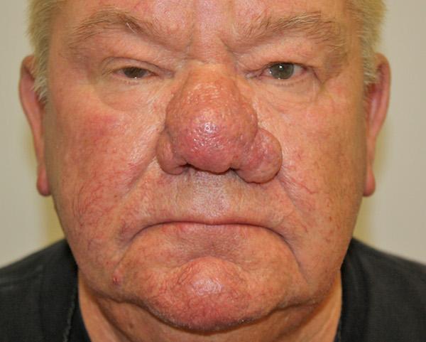 Functional Rhinoplasty before at Dr. Zarrabi Plastic Surgery in Beverly Hills, CA