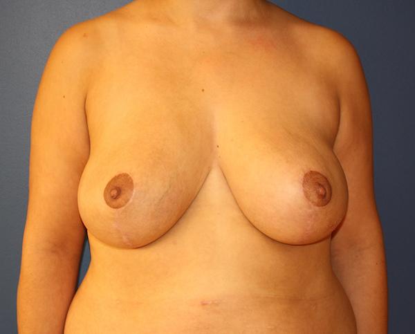 Breast Reduction after at Dr. Zarrabi Plastic Surgery in Los Angeles, CA
