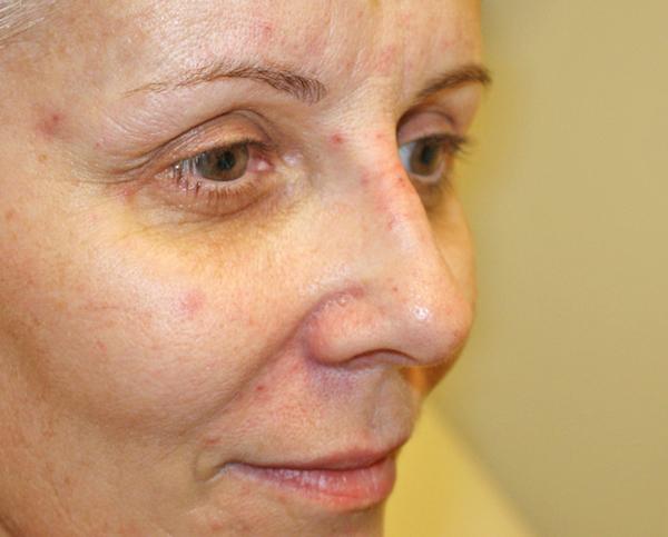 Dr. Zarrabi Plastic Surgery after — Los Angeles, CA