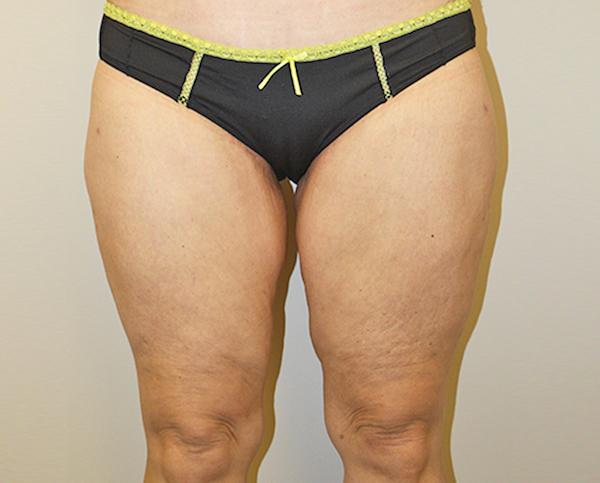 Thigh Lift after at Dr. Zarrabi Plastic Surgery in Beverly Hills, CA