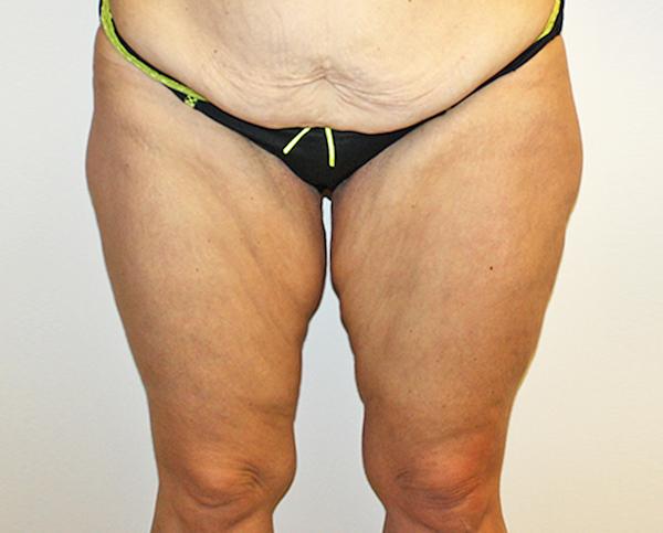 Thigh Lift before at Dr. Zarrabi Plastic Surgery in Beverly Hills, CA