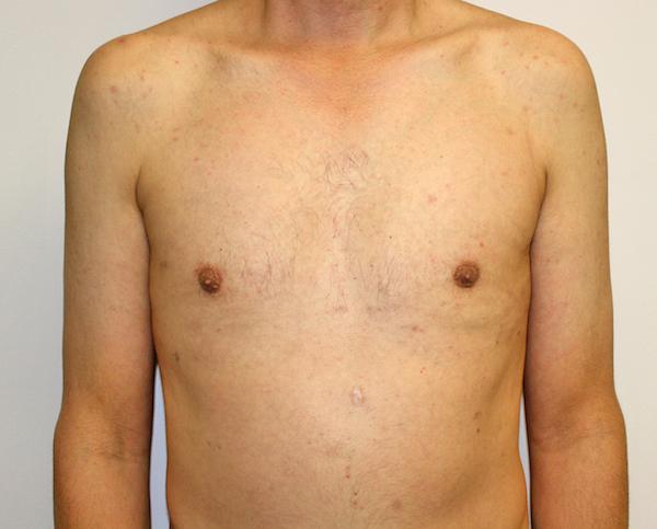 Gynecomastia Surgery after at Dr. Zarrabi Plastic Surgery in Los Angeles, CA