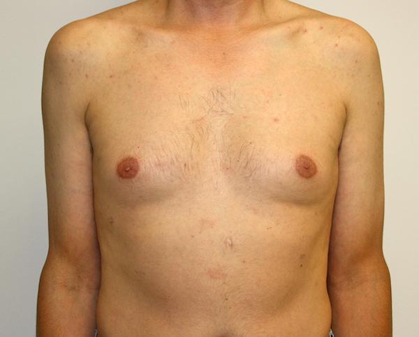 Gynecomastia Surgery before at Dr. Zarrabi Plastic Surgery in Los Angeles, CA