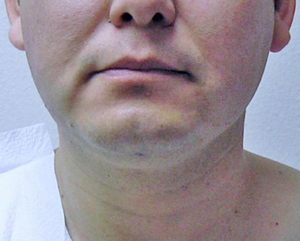 Neck Liposuction after at Dr. Zarrabi Plastic Surgery in Los Angeles, CA