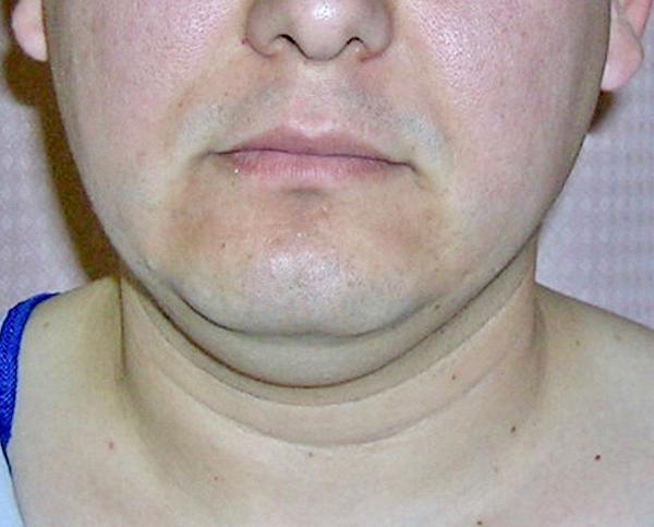Neck Liposuction before at Dr. Zarrabi Plastic Surgery in Los Angeles, CA