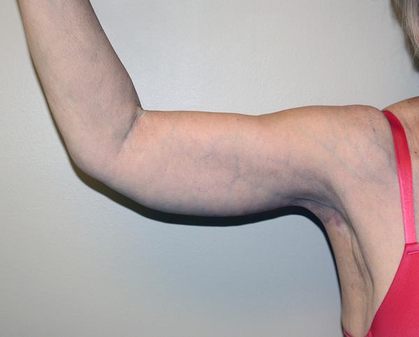 Arm Lift after at Dr. Zarrabi Plastic Surgery in Beverly Hills, CA
