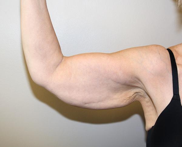 Arm Lift before at Dr. Zarrabi Plastic Surgery in Beverly Hills, CA
