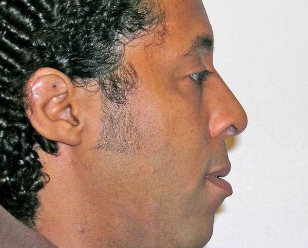 Rhinoplasty after at Dr. Zarrabi Plastic Surgery in Los Angeles, CA
