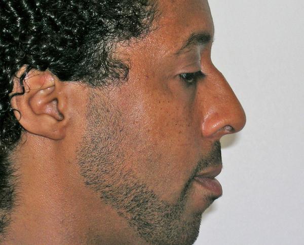 Rhinoplasty before at Dr. Zarrabi Plastic Surgery in Los Angeles, CA