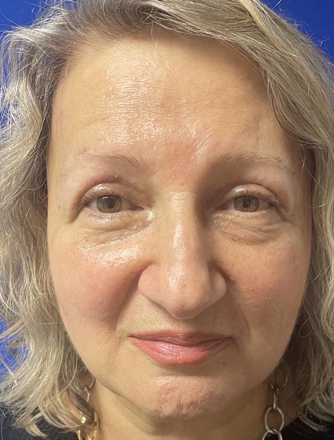 Cohn Plastic Surgery eyelid lift after — Franklin Square, NY