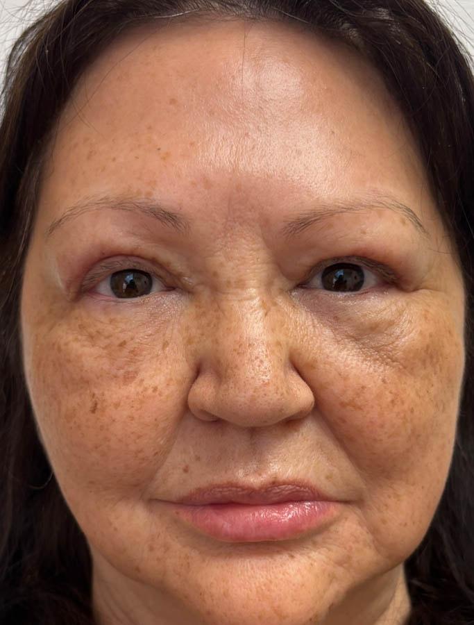 Cohn Plastic Surgery brow lift after — Franklin Square, NY