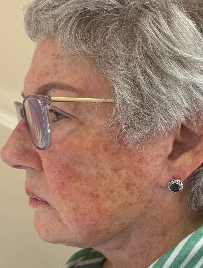 Cohn Plastic Surgery facelift after — Franklin Square, NY