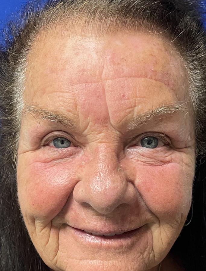 Cohn Plastic Surgery eyelid lift after — Franklin Square, NY