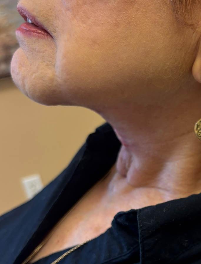 Cohn Plastic Surgery facelift after — Franklin Square, NY