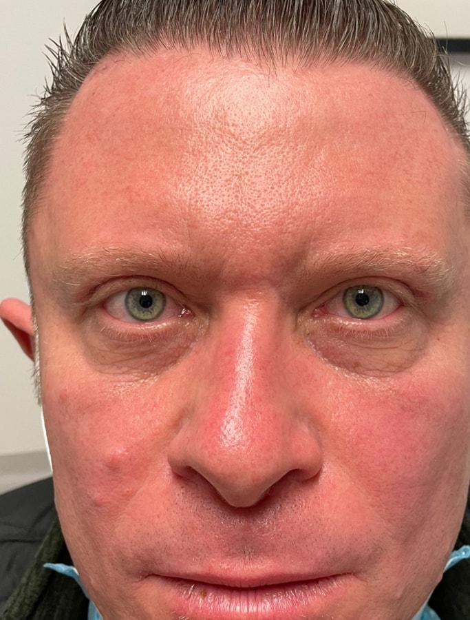 Cohn Plastic Surgery eyelid lift after — Franklin Square, NY