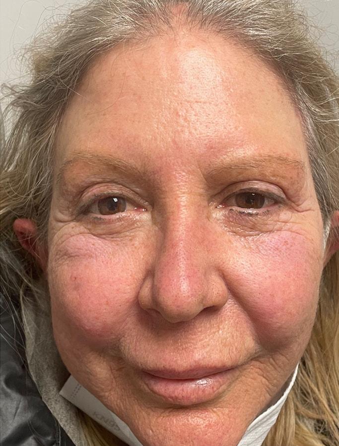 Cohn Plastic Surgery eyelid lift after — Franklin Square, NY