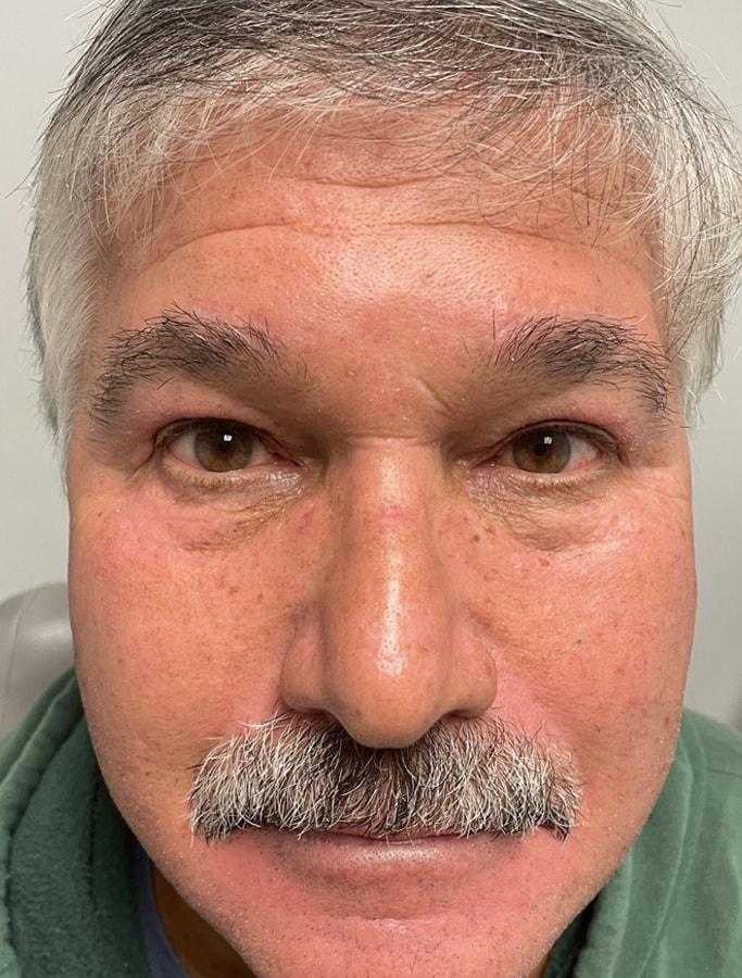 Cohn Plastic Surgery eyelid lift after — Franklin Square, NY