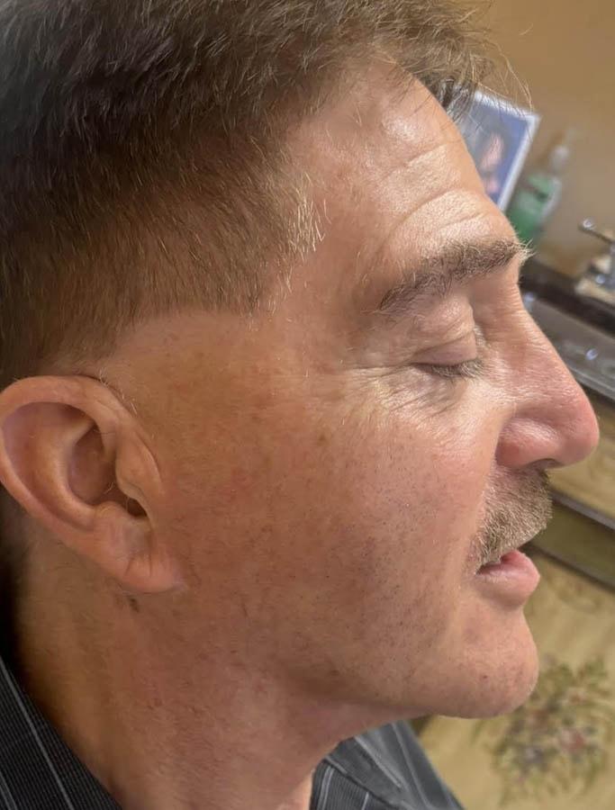 Cohn Plastic Surgery facelift after — Franklin Square, NY