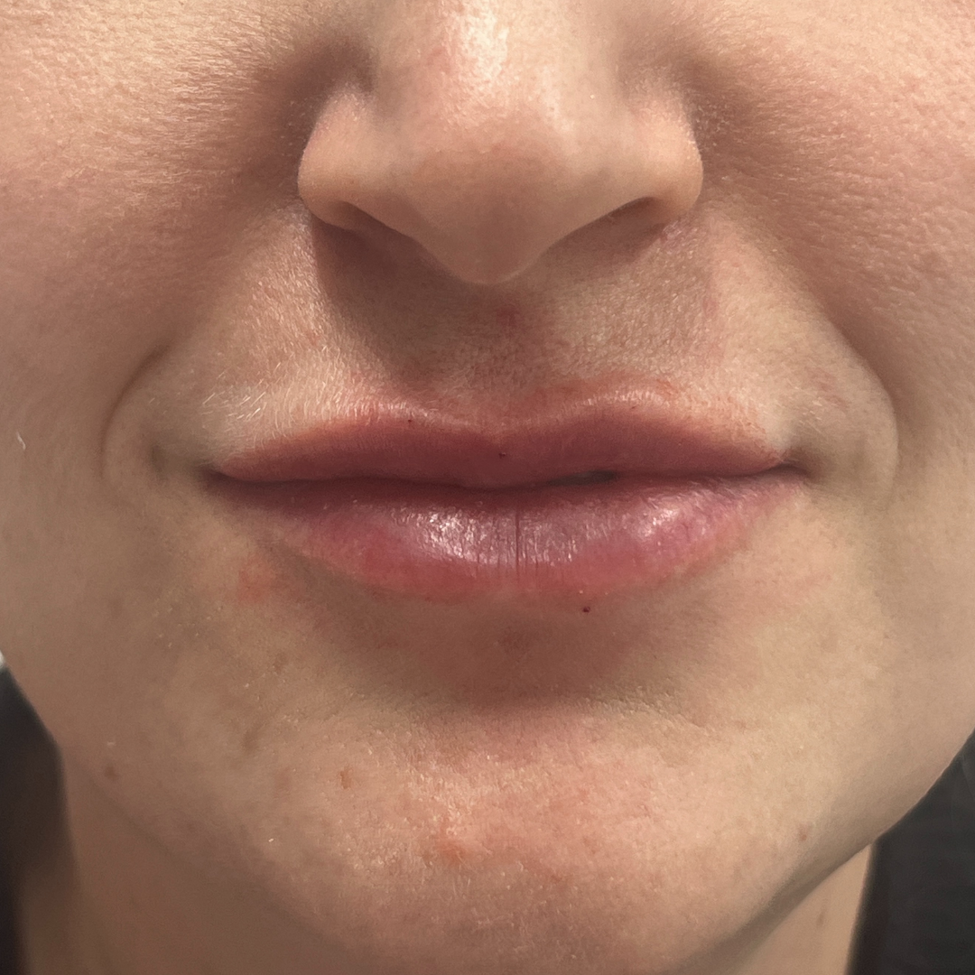 Pure Envy Med Spa after — Orlando, FL