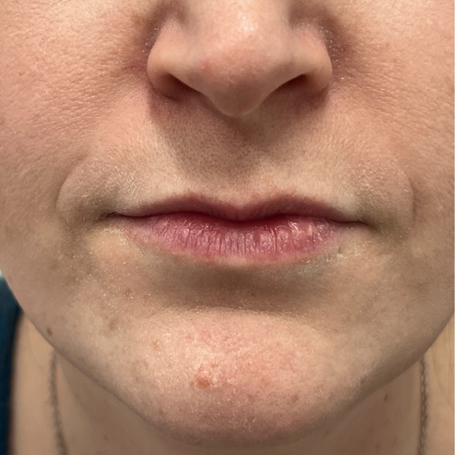 Lip Filler before at Pure Envy Med Spa in Orlando, FL