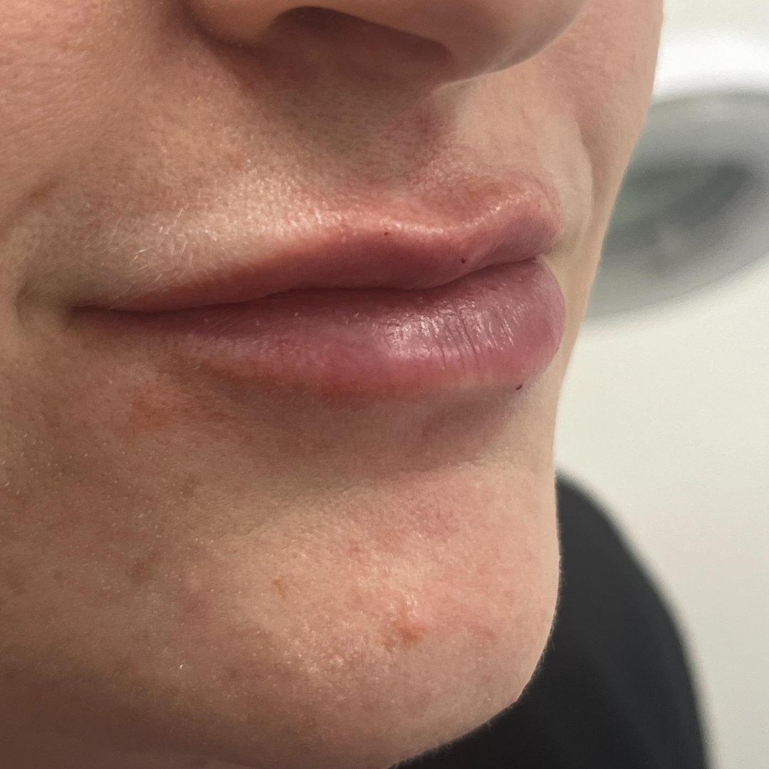 Pure Envy Med Spa after — Orlando, FL