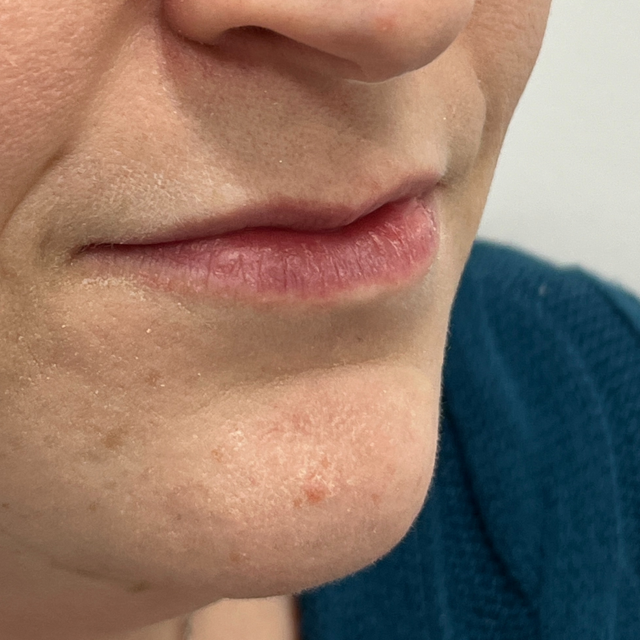 Lip Filler before at Pure Envy Med Spa in Orlando, FL
