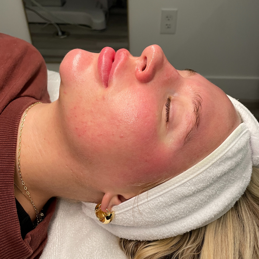 Pure Envy Med Spa after — Orlando, FL
