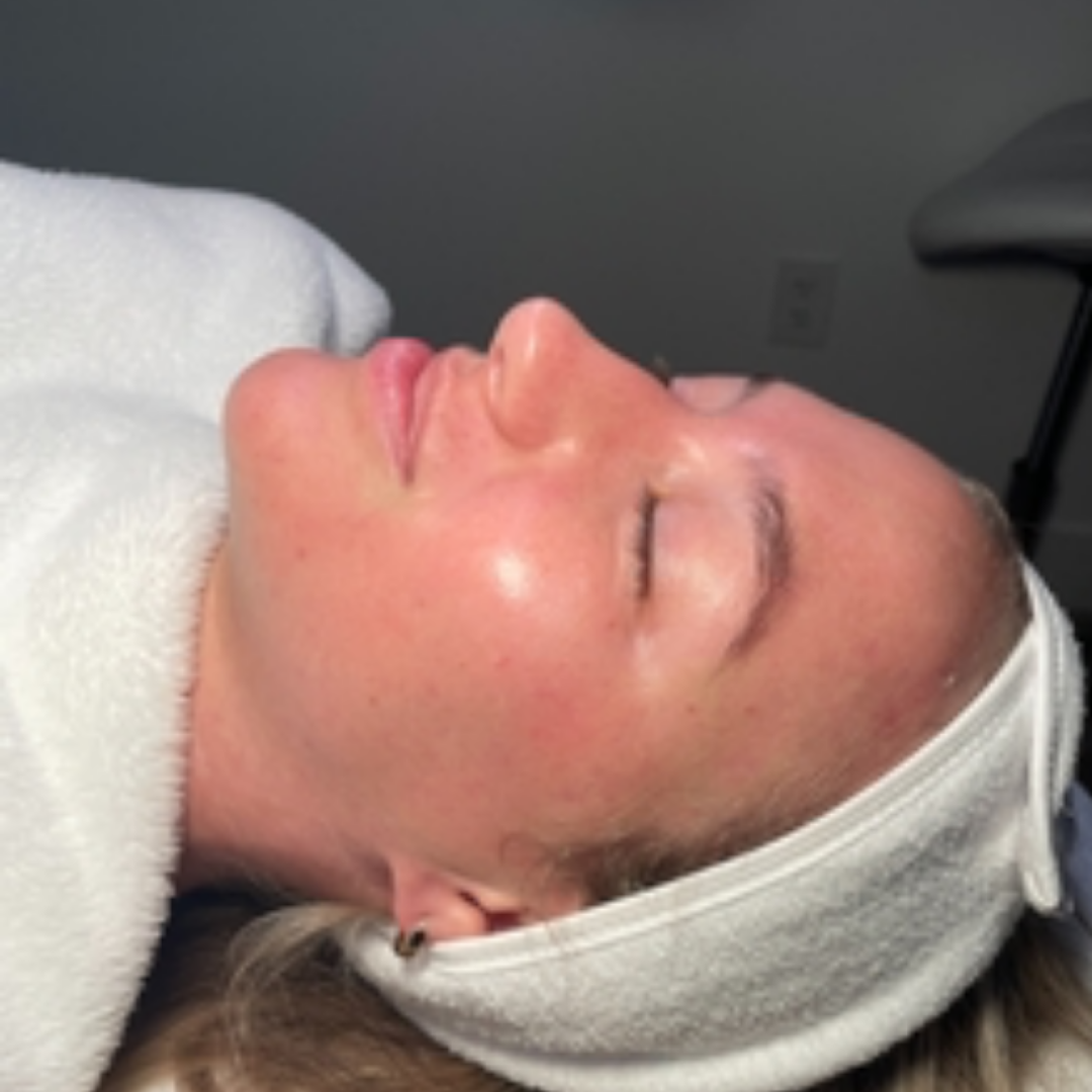 Pure Envy Med Spa after — Orlando, FL