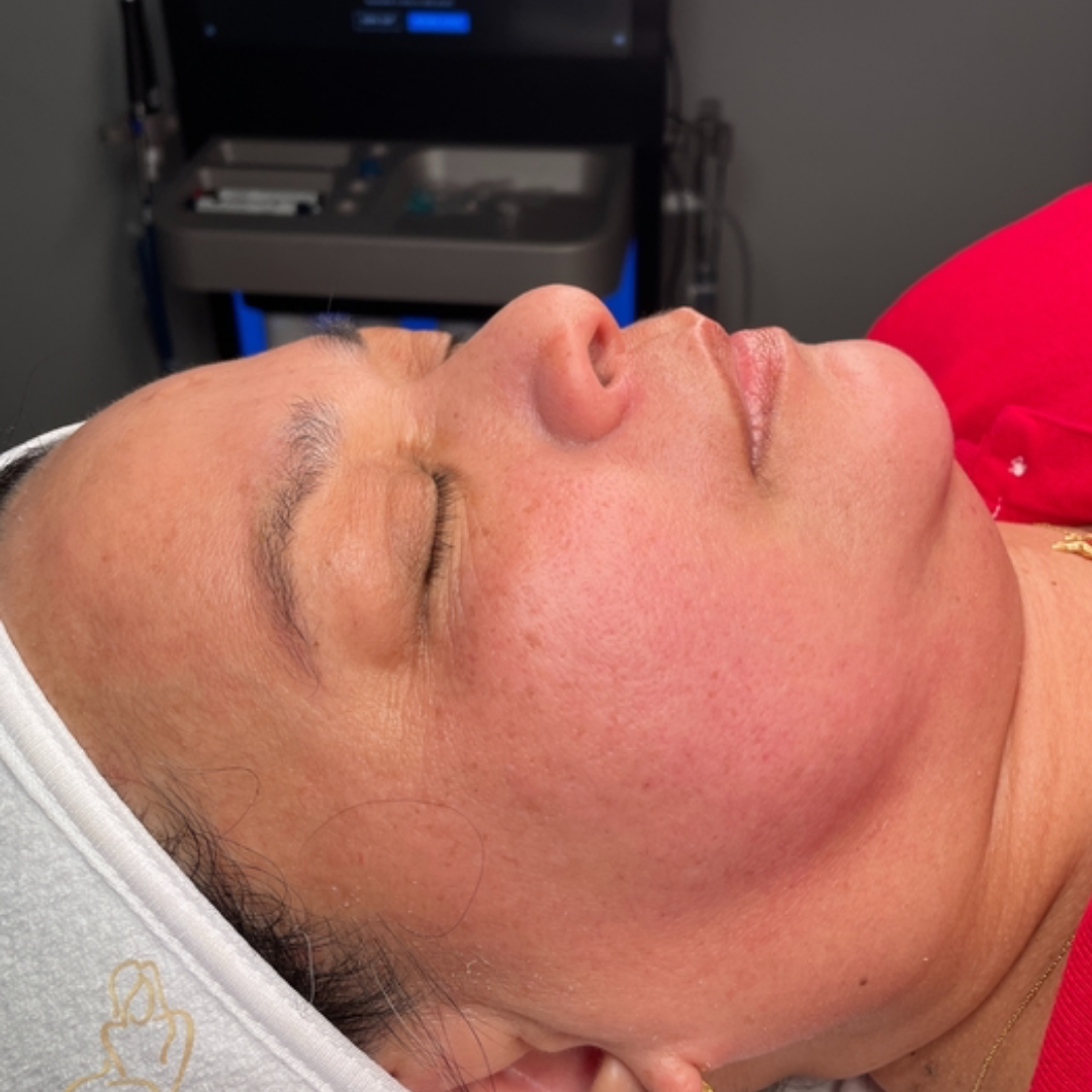Pure Envy Med Spa after — Orlando, FL