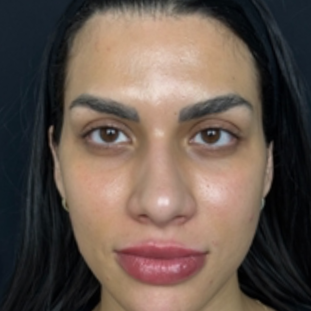 Lip Filler after at Pure Envy Med Spa in Orlando, FL