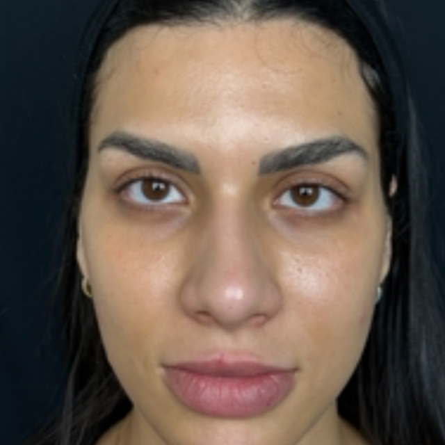 Lip Filler before at Pure Envy Med Spa in Orlando, FL