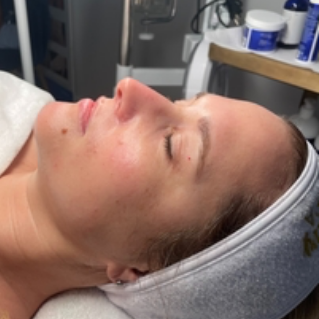 Pure Envy Med Spa after — Orlando, FL
