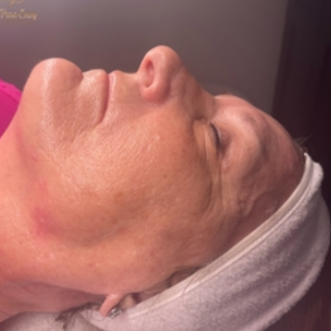 Pure Envy Med Spa after — Orlando, FL