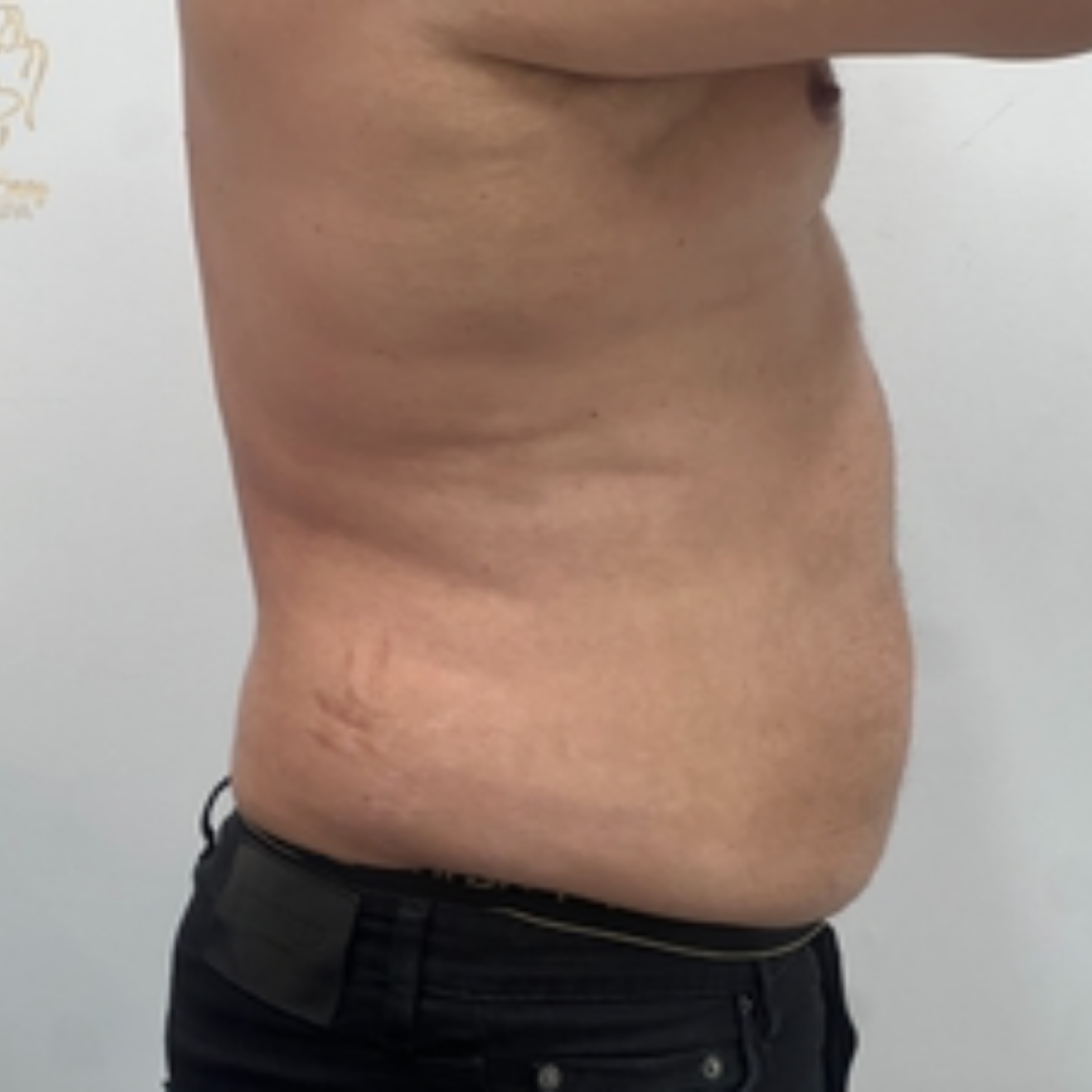 Pure Envy Med Spa after — Orlando, FL