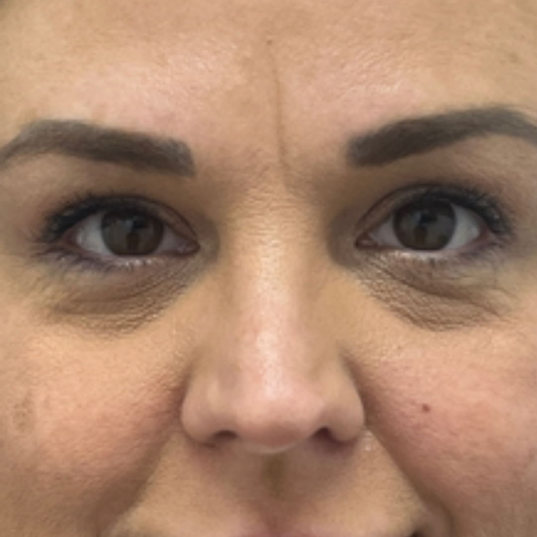 Pure Envy Med Spa after — Orlando, FL