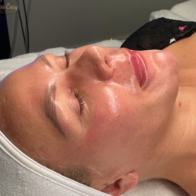 Lip Filler before at Pure Envy Med Spa in Orlando, FL