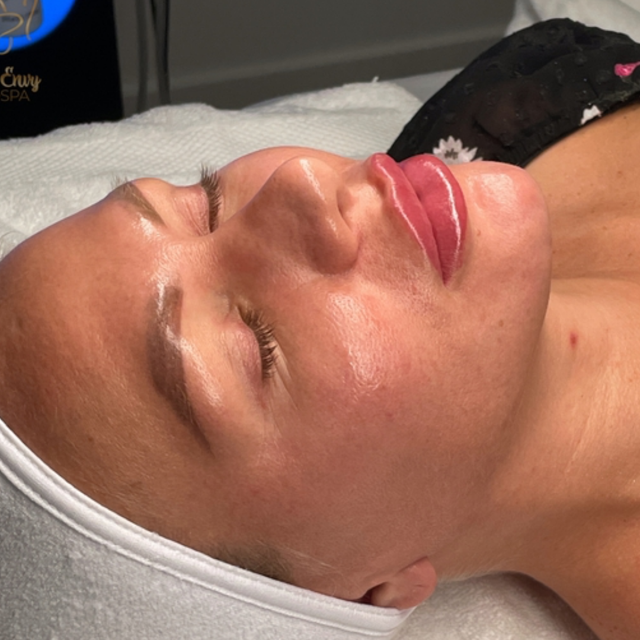 Lip Filler after at Pure Envy Med Spa in Orlando, FL
