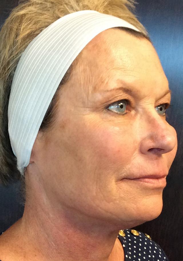 Facelift after at Aesthetic Alternatives in Louisville, KY