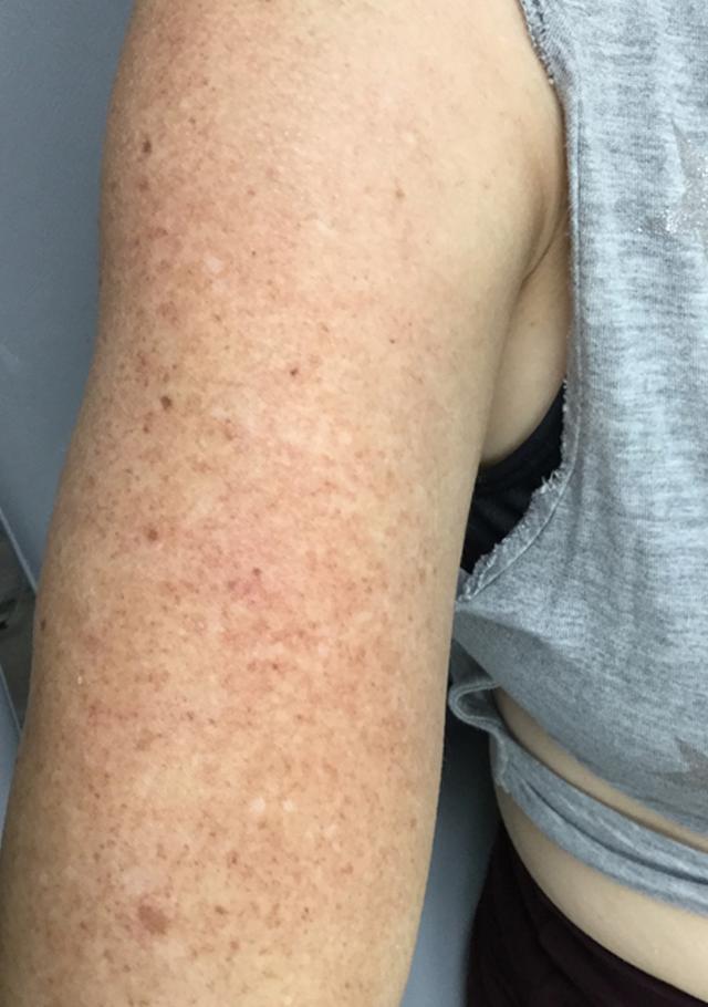 Laser Skin Resurfacing before at Aesthetic Alternatives in Louisville, KY