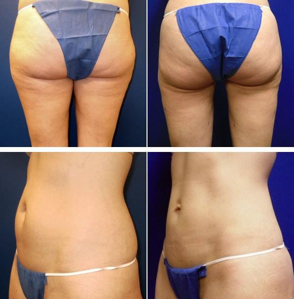 Liposuction result at Plastic Surgeon Richard Fryer in Draper, UT