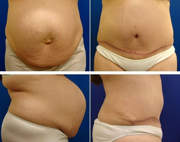 Mini Tummy Tuck result at Plastic Surgeon Richard Fryer in Draper, UT